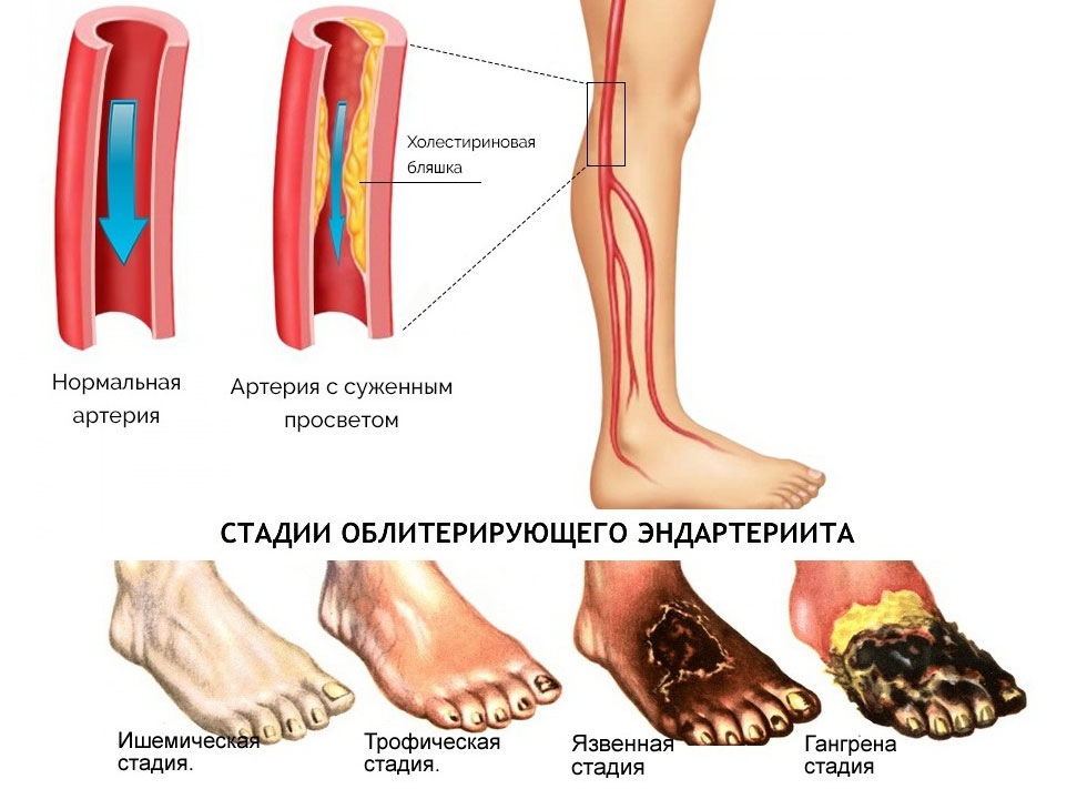Стадии Схема стадий облитерирующего эндартериита